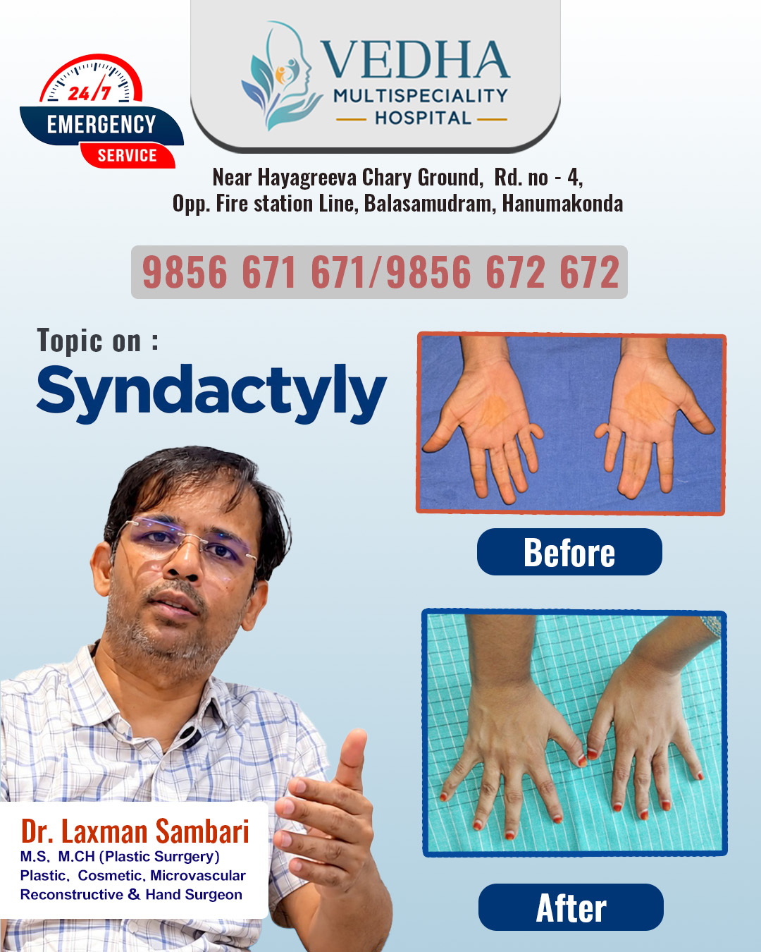 syndactyly before & after