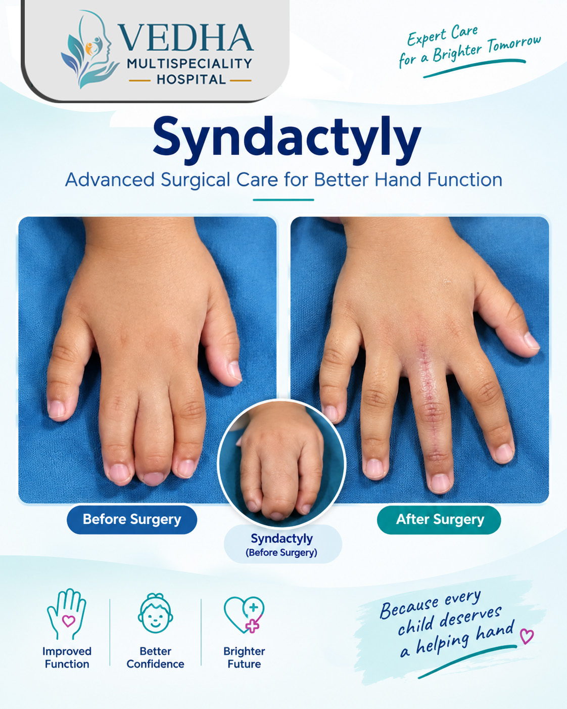 syndactyly