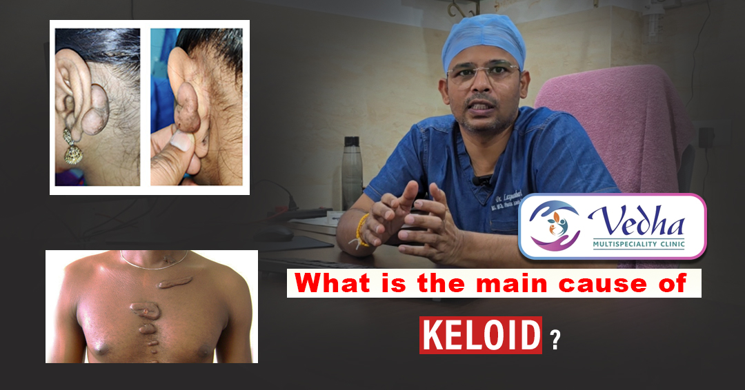 What is the main cause of keloid ?
