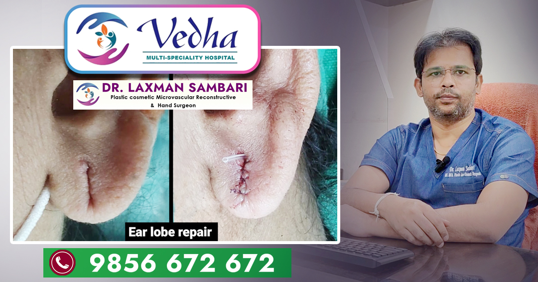 Ear Lobe Sagging || మీరు చెవులకు ఇయర్ రింగ్స్ వేసుకోవడం వల్ల చెవి హ్యాంగ్ అవడం