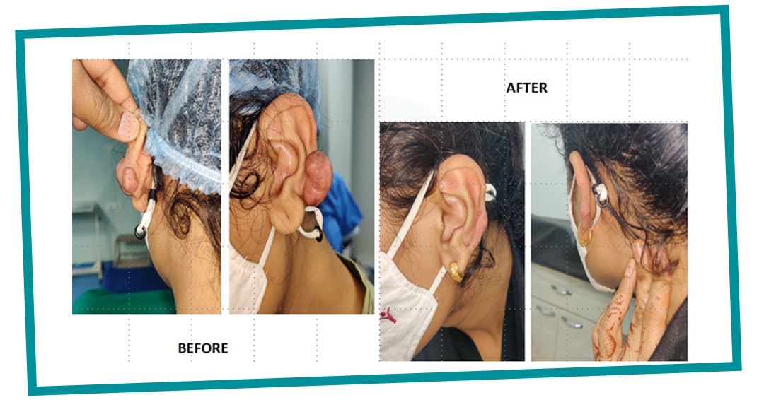 Best Keloid Treatment by Dr. Laxman Sambari in Hanumakonda