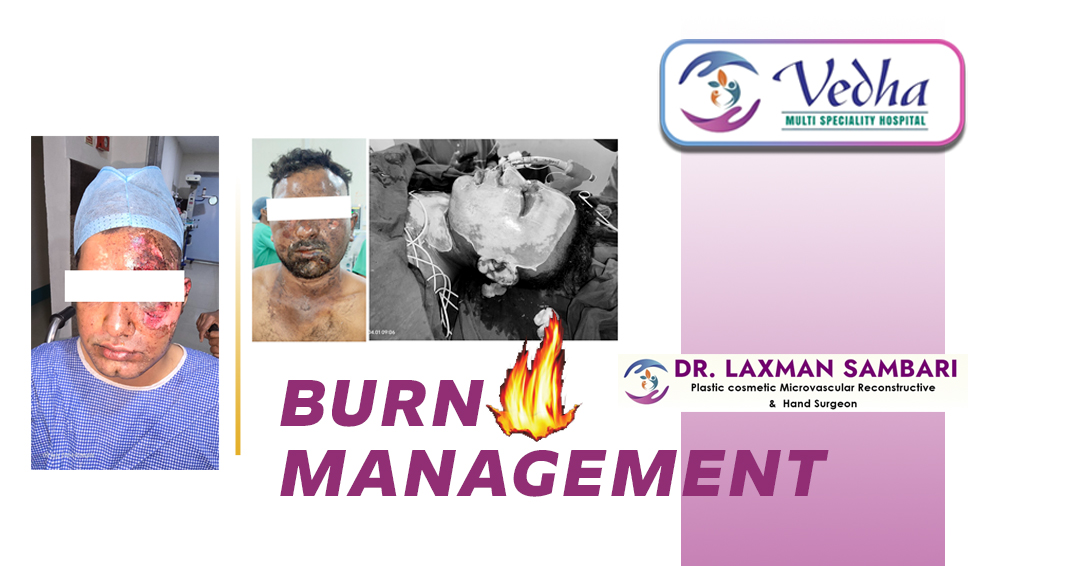 Burn Injury Treatment and Care