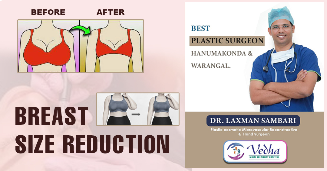 Breast size reduction