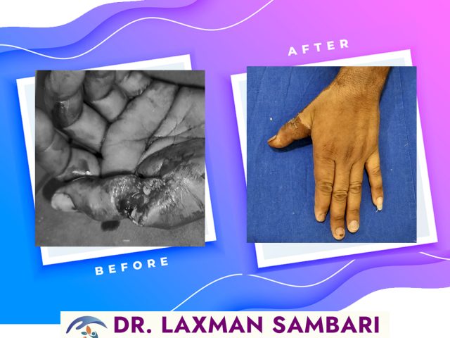 Thumb Finger Injury Treatment at Vedha Multi-Specialty Hospital, Hanumakonda