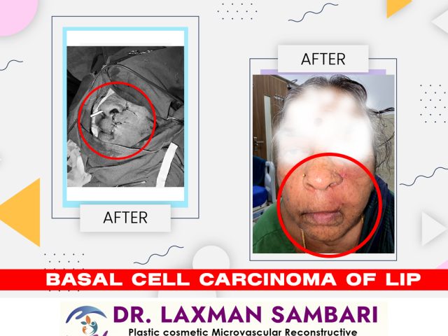 Dr. Laxman Sambari: A Renowned Specialist in Basal Cell Carcinoma of the Lip