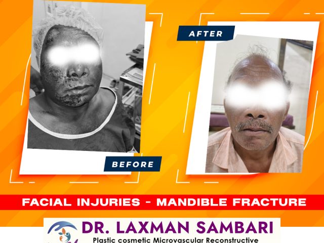 Excellent Recovery from Mandible Fracture – Treated by Dr. Laxman Sambari
