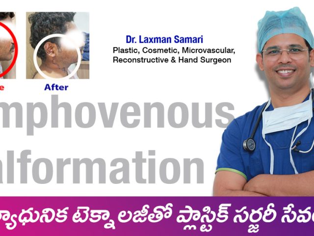 Lymphovenous Malformation