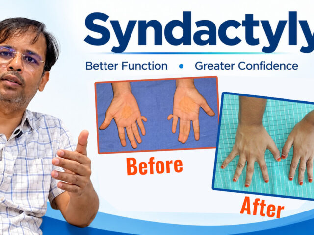 Syndactyly Surgery – Restoring Finger Separation, Function & Confidence