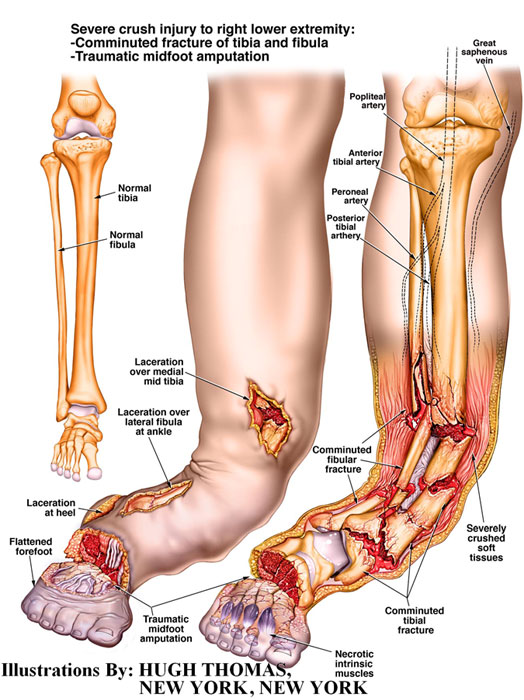 crush injuries
