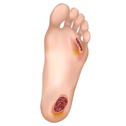 diaatic foot care