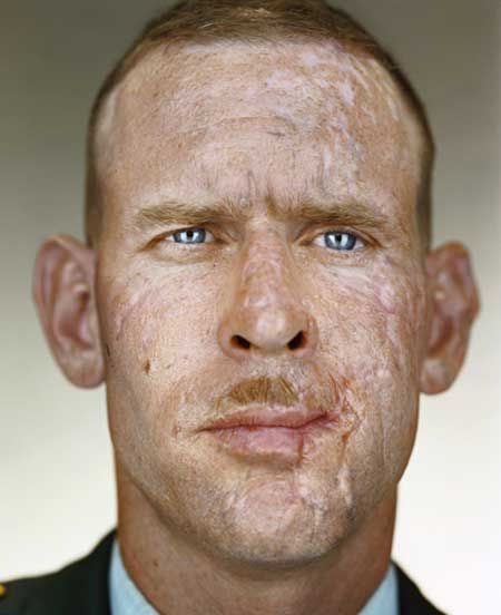 facial trauma