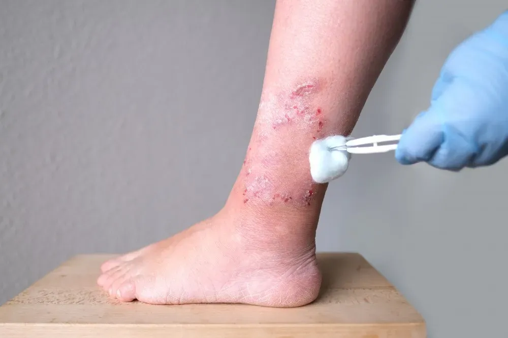 non healing wound