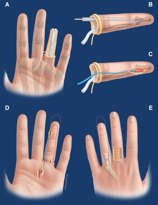 replantation surgery