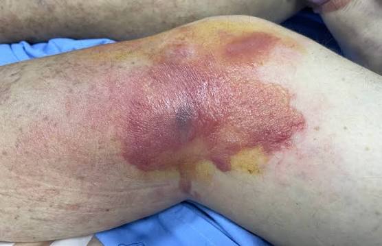 soft tissue injuries