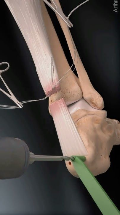 tendon injuries